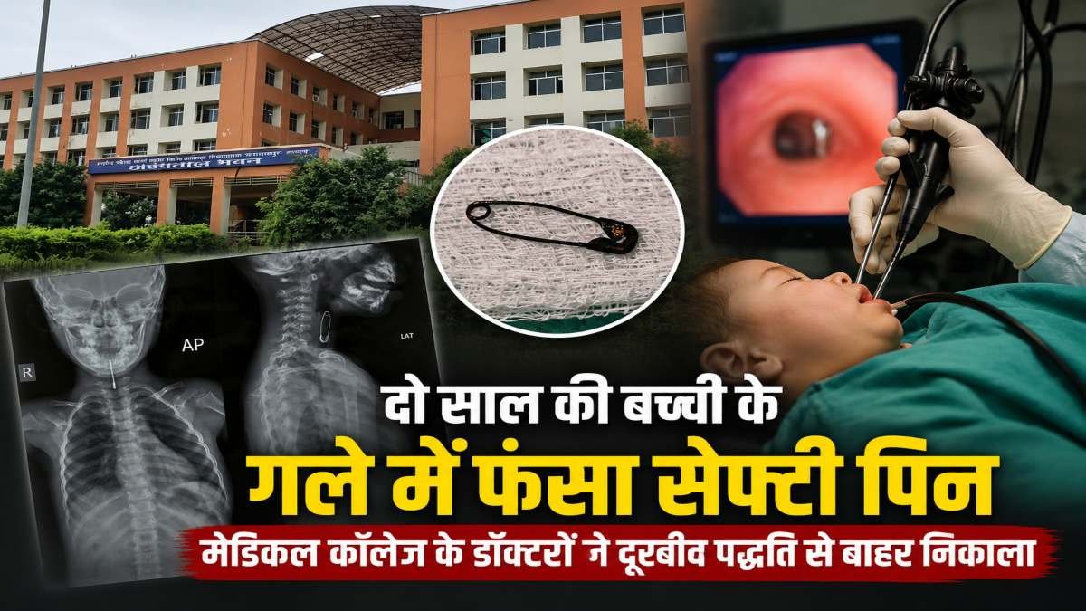 दो साल की बच्ची के गले में फंसा सेफ्टी पिन, डॉक्टरों ने दूरबीन पद्धति से निकालकर बचाई जान